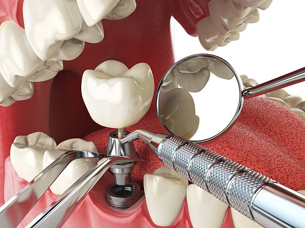 Best Emergency Dental Care for Broken or Chipped Teeth in Cedar Grove, WI